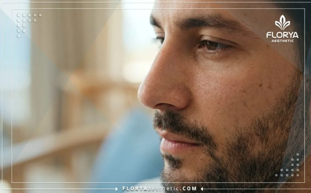 نتيجة مثالية وطبيعية لعملية تجميل أنف رجالي بملامح متناسقة وجذابة.
